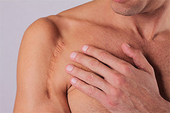 man with scars being massaged