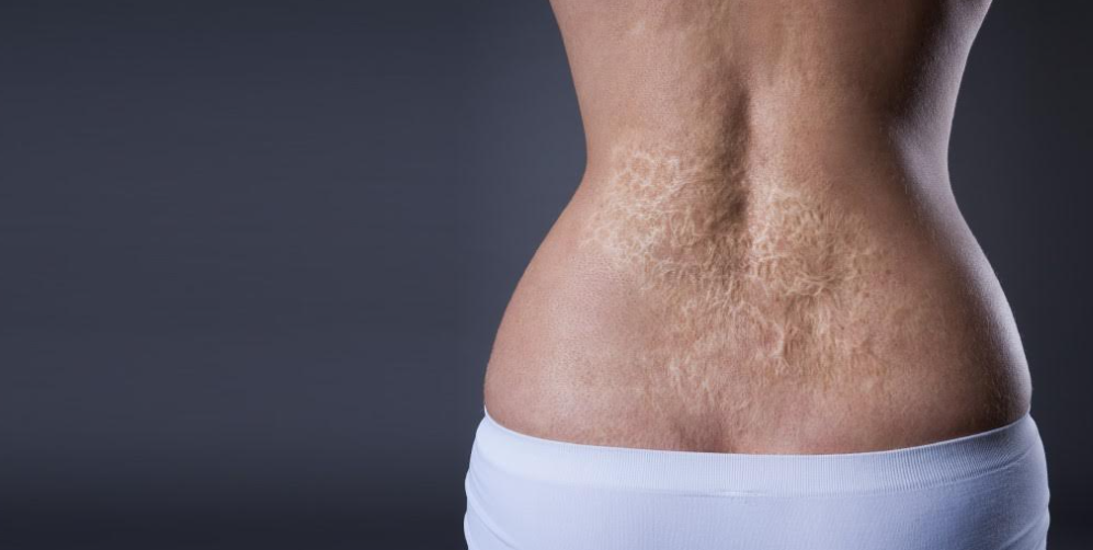 Therapeutic Strategies for Surgeries, Scars and Burns with Pete Whitridge